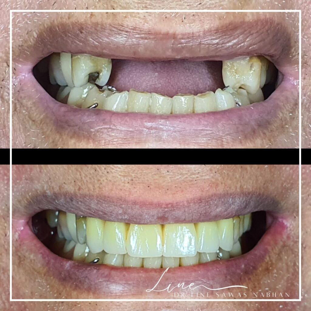 dentist-agdal-implant-dentaire