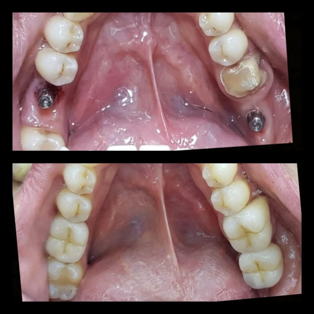 implant-dentaire-agdal