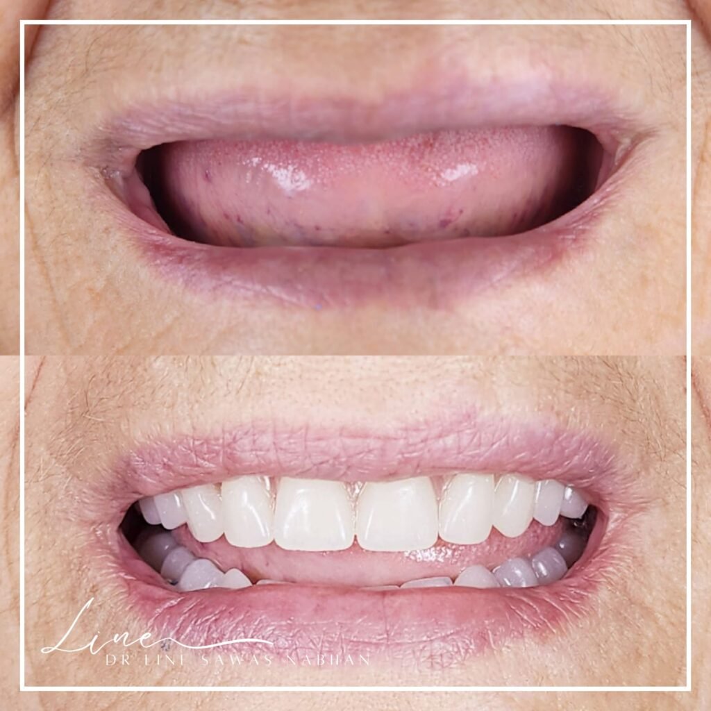 prothèse-sur-implant-rabat