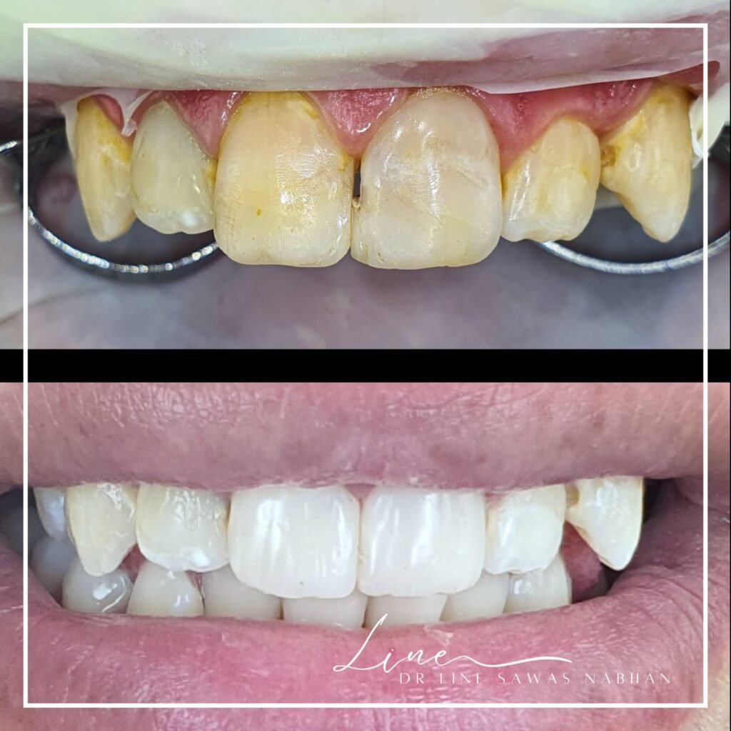 Transformation avec facettes dentaires par dentiste à Agdal Rabat