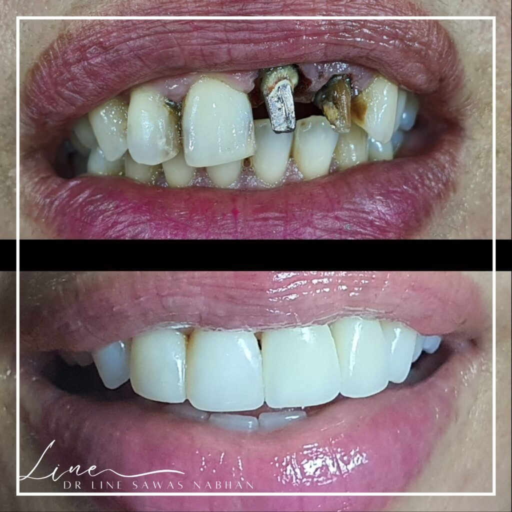 Avant et après facettes dentaires par dentiste à Agdal, Rabat